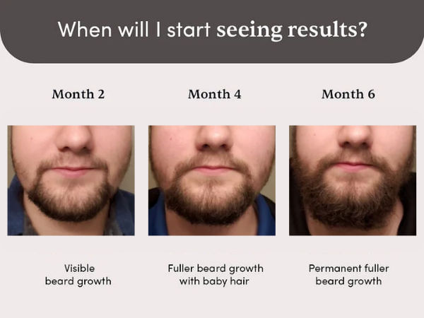 beardmax 5 minoxidil beard growth serum 30 ml